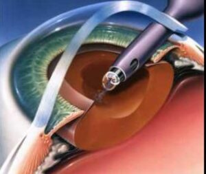 OPSIS. FACOEMULSIFICACION