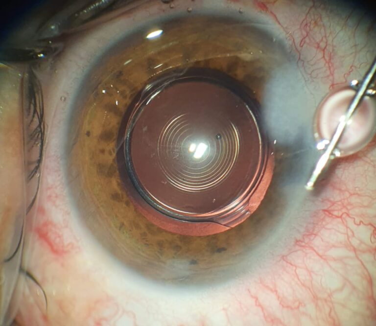 OPSIS. LENTE INTRAOCULAR MULTIFOCAL