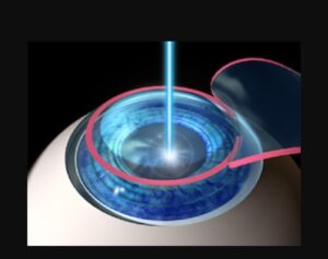 OPSIS. LASER LASIK