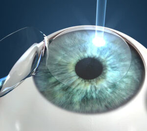 OPSIS. Laser Lasik