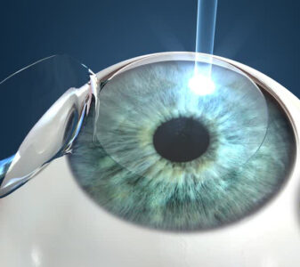 OPSIS. Laser Lasik