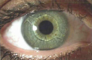 OPSIS. Lente intraocular